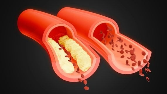 lower high cholesterol